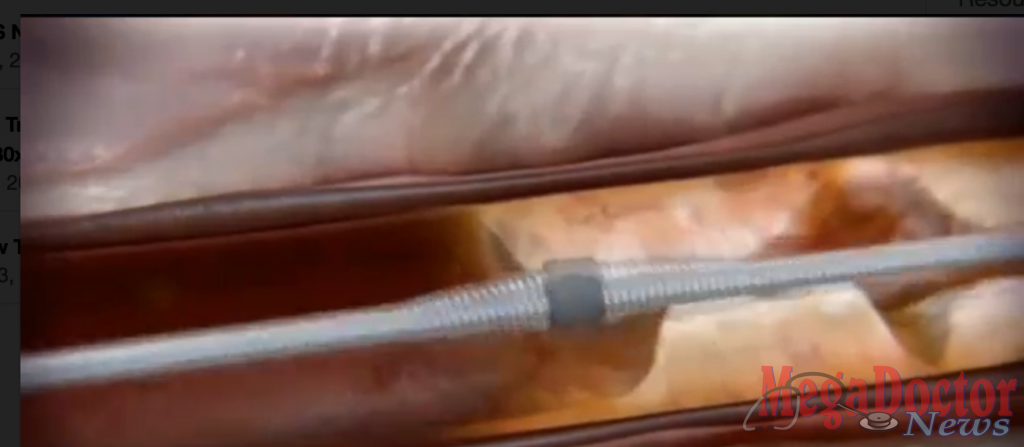 Diamondback 360® Coronary Orbital Atherectomy System” can go into arteries where no one has gone before – because these blood vessels are so hardened with fat, cholesterol and plaque that doctors can’t get balloons or stents into them (unfortunately, in the Valley that is very common, because of high-fat, high cholesterol diets, diabetes and high blood pressure, all of which increase the risk of coronary artery disease.