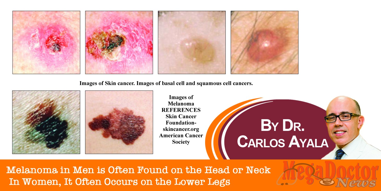 Melanoma in Men is Often Found on the Head or Neck In Women, It Often ...