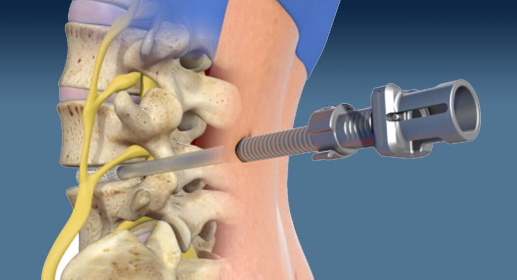 Minimallt Invasive procedure known as Spineology OptiLIF. Image courtesy of Newswise.