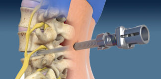 Minimallt Invasive procedure known as Spineology OptiLIF. Image courtesy of Newswise.