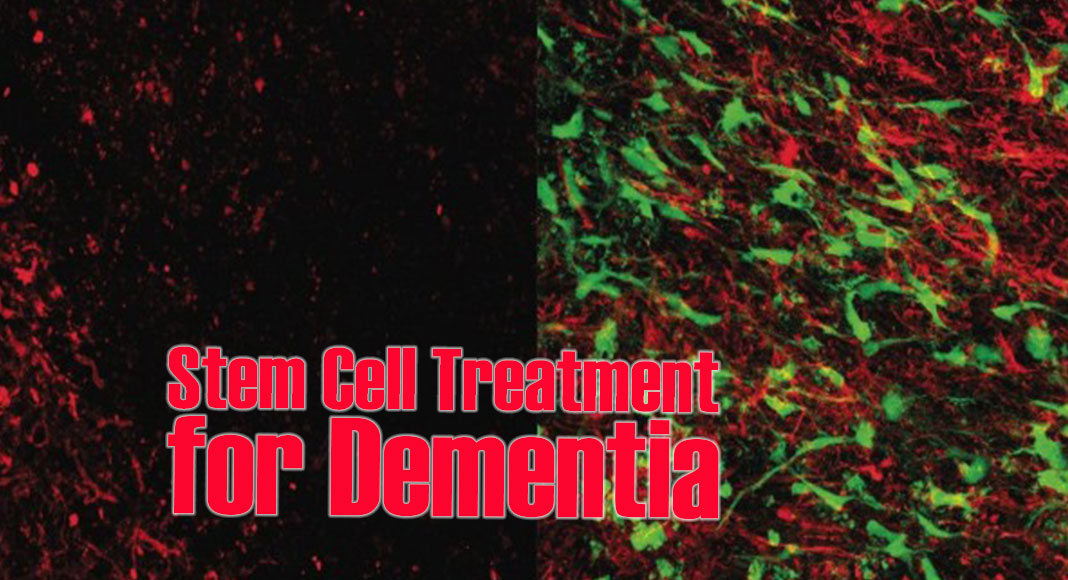 Newswise: Stem Cell Treatment for Dementia Clears Major Hurdle