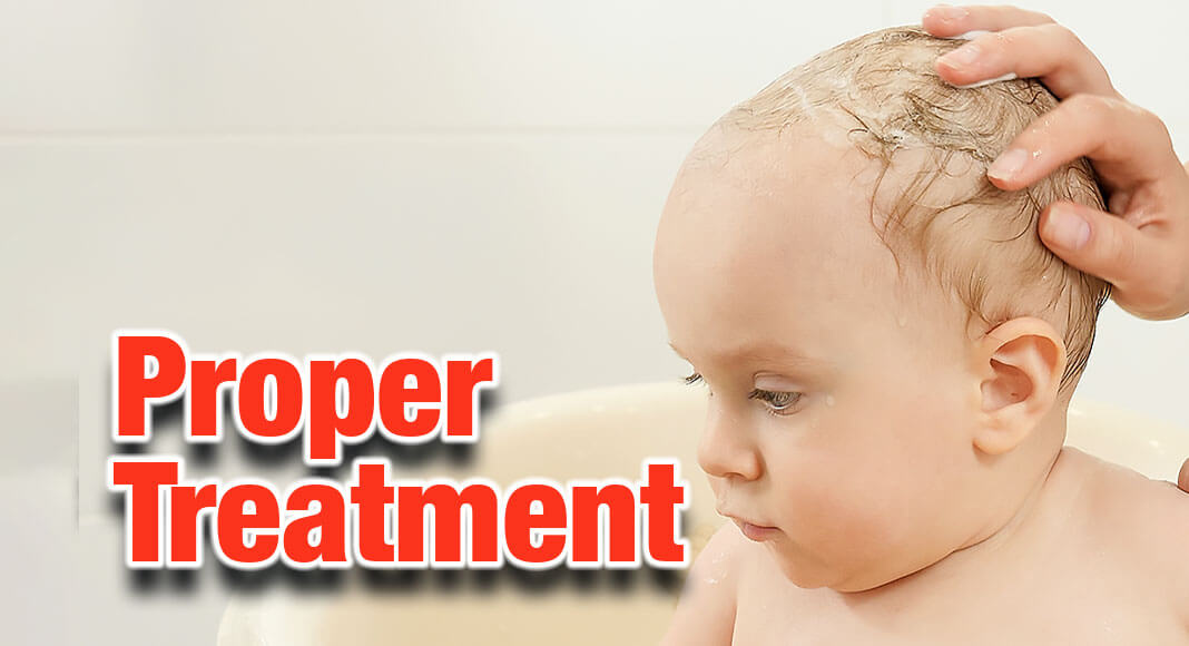 4 Cradle Cap Tips Mega Doctor News