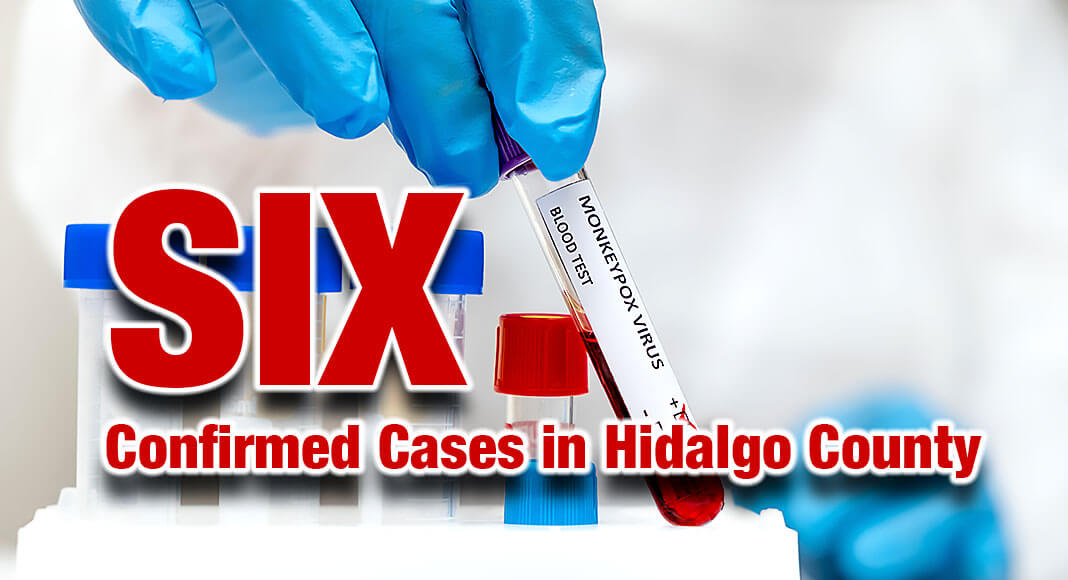 The confirmed number of monkeypox cases in Hidalgo County has risen to six, according to the Hidalgo County Health and Human Services Department. Image for illustration purposes