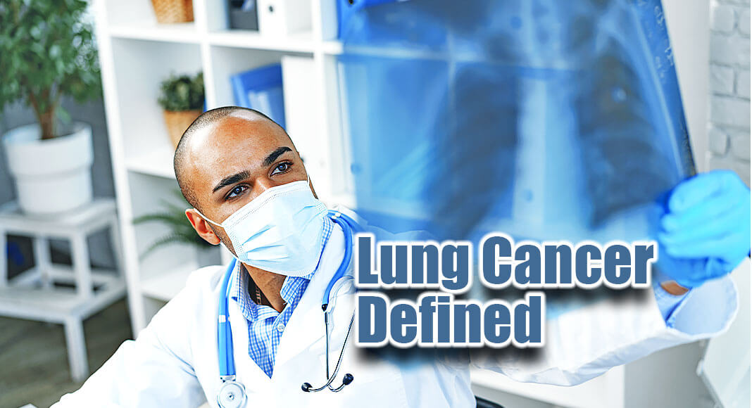 Lung cancer begins in the lungs and may spread to lymph nodes or other organs in the body, such as the brain. Cancer from other organs also may spread to the lungs. Image for illustration purposes