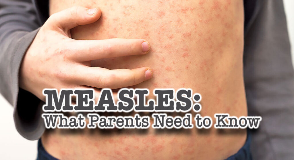 What Parents Need to Know About Measles - Mega Doctor News