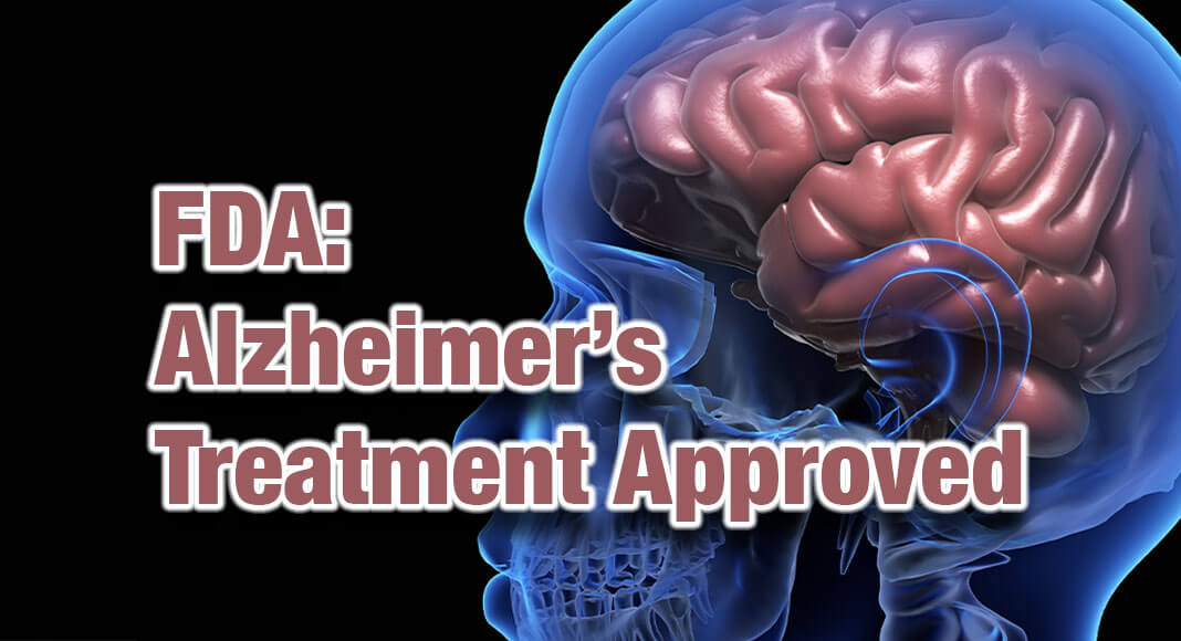 The U.S. Food and Drug Administration approved Leqembi (lecanemab-irmb) via the Accelerated Approval pathway for the treatment of Alzheimer’s disease. Leqembi is the second of a new category of medications approved for Alzheimer’s disease that target the fundamental pathophysiology of the disease. Image for illustration purposes