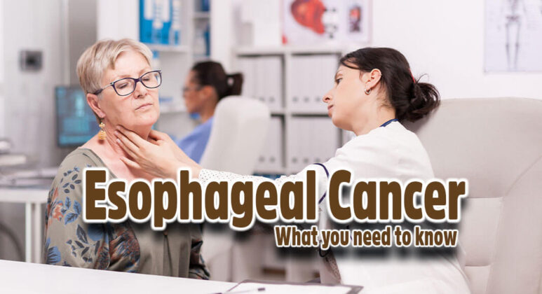 What You Should Know About Esophageal Cancer - Mega Doctor News