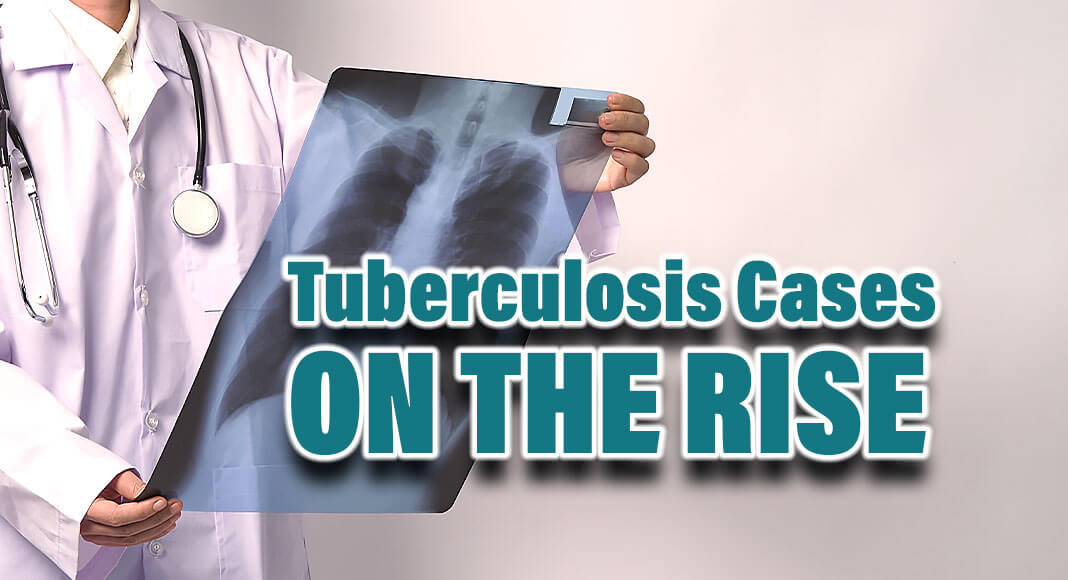 TB disease cases in 2022 increased but did not return to pre-pandemic levels. Image for illustration purposes
