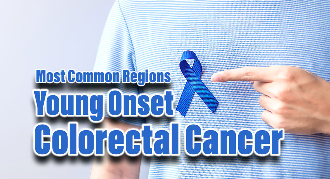 March is Colorectal Cancer Awareness Month. And research from Cleveland Clinic shows young onset colorectal cancer deaths seem to be more prevalent in certain parts of the country. Image for illustration purposes