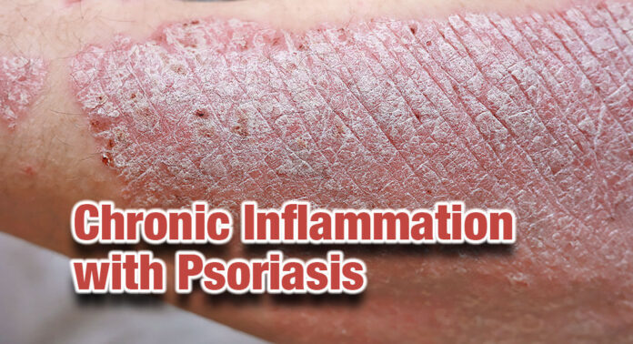 Managing Chronic Inflammation With Psoriasis - Mega Doctor News