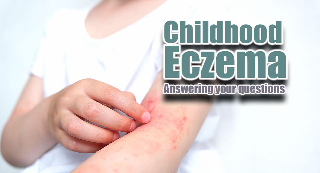 Eczema, also called atopic dermatitis, is a common, itchy skin condition in childhood. Image for illustration purposes