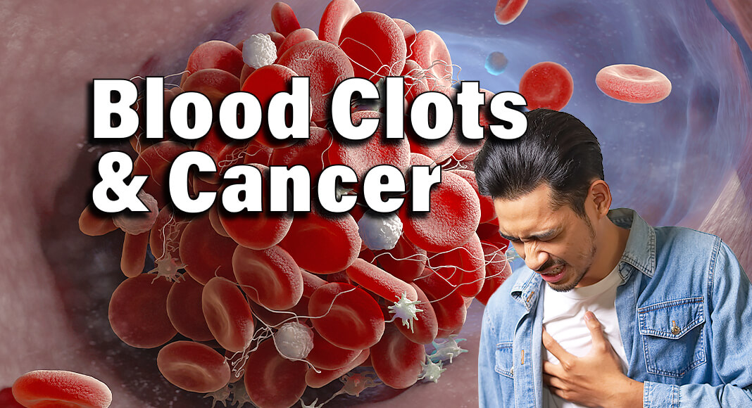 While everyone is at risk for developing a blood clot (also called venous thromboembolism or VTE), having cancer and some of its treatments increase the risk for a blood clot. Image for illustration purposes
