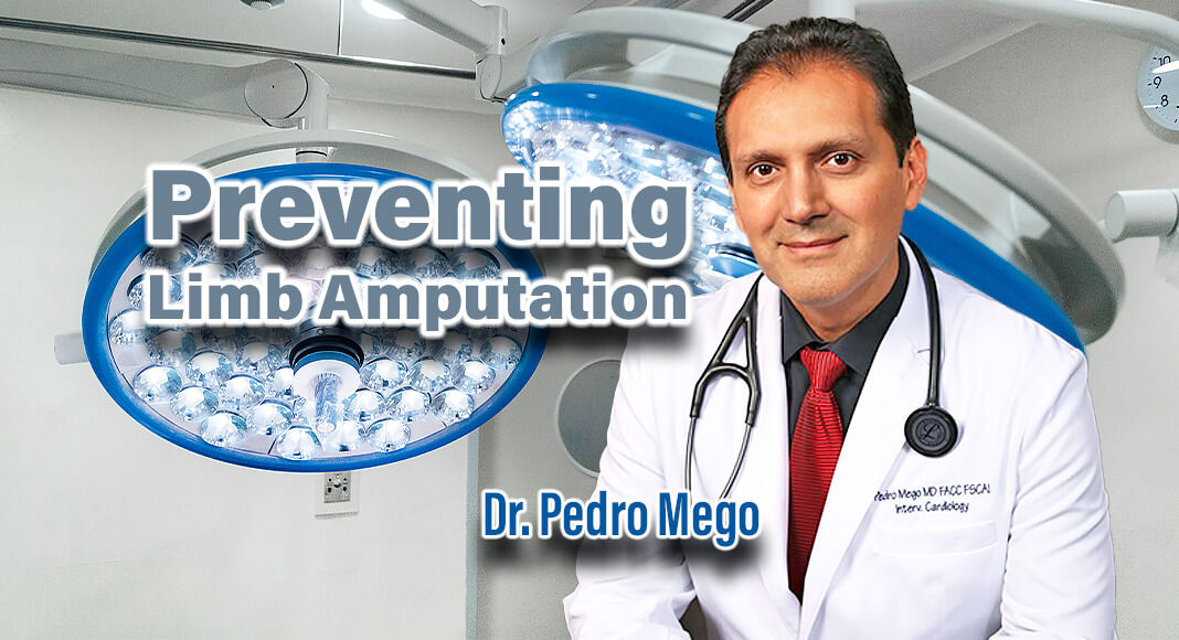 Dr. Pedro Mego is a board-certified Interventional Cardiologist (FSCAI) with special interest in Peripheral Artery Disease and Chronic Venous Diseases. He is an Endovascular Diplomate of the American Board of Vascular Medicine. Courtesy image