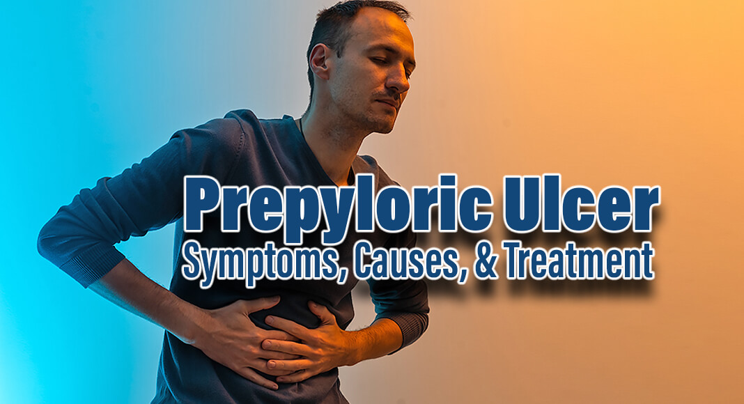 Prepyloric ulcers are a type of peptic or gastric ulcer. These open sores develop in the upper digestive tract, just above the pylorus, which is the opening to the small intestine. Image for illustration purposes
