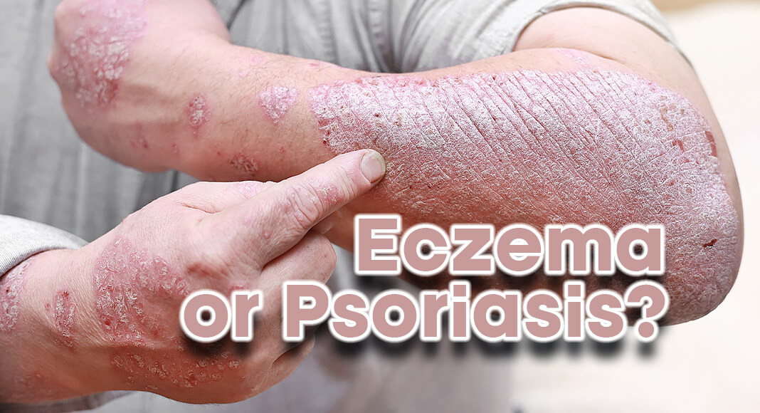 Eczema and psoriasis are common skin conditions, and they can both appear as rashes that may itch or burn. If you get rashes often, you might wonder if you have one or the other. In fact, you could have both eczema and psoriasis at the same time, but it’s rare. Image for illustration purposes