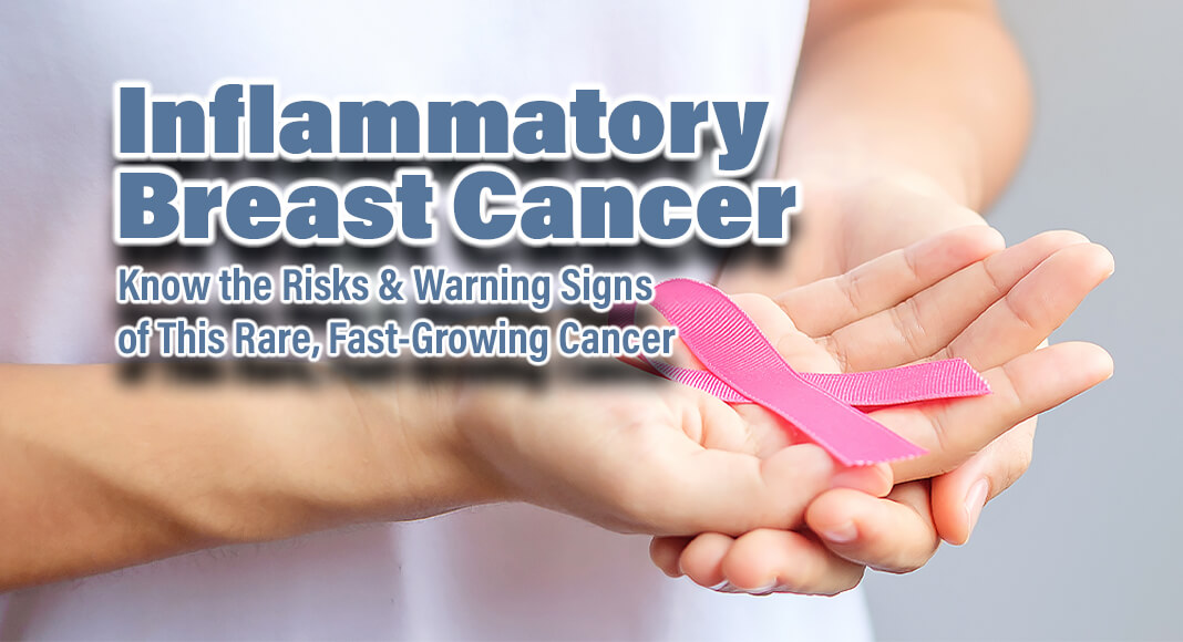 Inflammatory breast cancer (IBC) is a rare type of breast cancer. It only accounts for one to five percent of all breast cancer cases, but it’s important to know your risk and the warning signs, as this form of the disease is aggressive, fast-growing, and hard to detect early. Image for illustration purposes