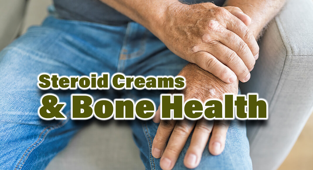  New research indicates that higher doses of topical corticosteroids, which are commonly used to treat inflammatory skin conditions, are linked with elevated risks of osteoporosis and bone fractures associated with osteoporosis. Image for illustration purposes