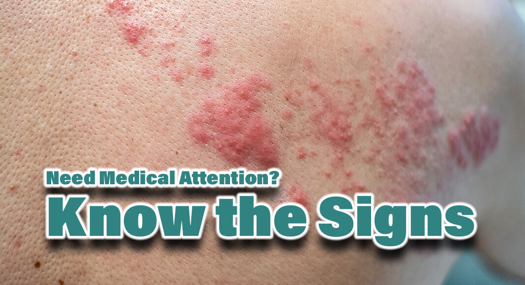  Rashes take many forms, may spread across the body, and affect people of all ages. To the untrained eye, rashes may look alike, and while some are treatable with over-the-counter medications, other rashes can be a sign of a more serious condition. Image for illustration purposes