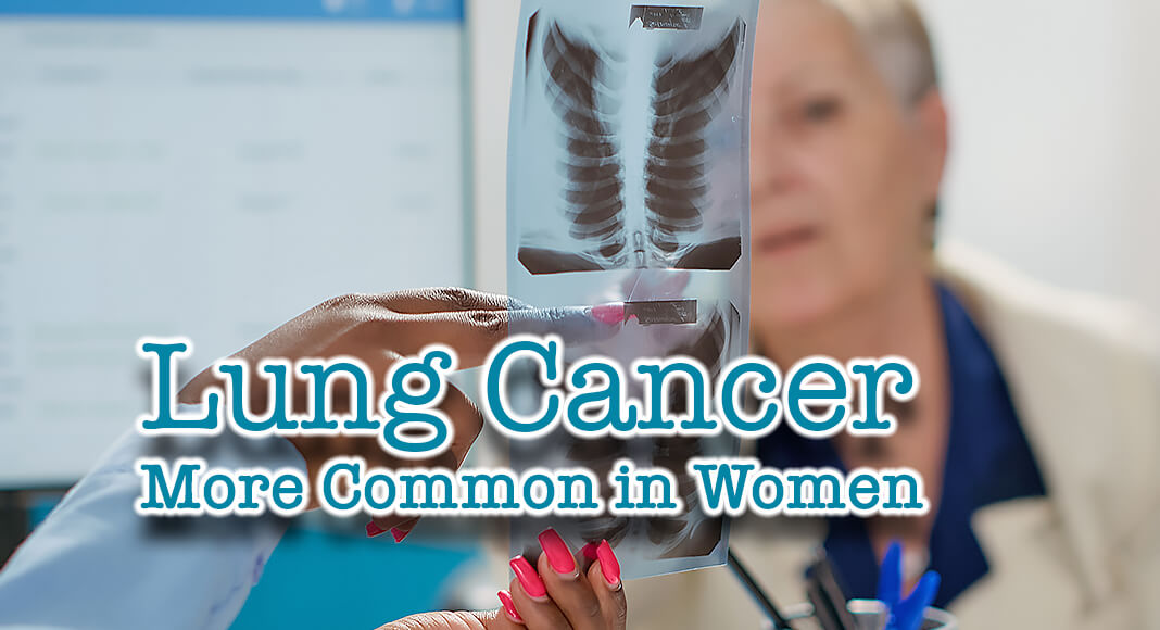 “Over the last decade, the incidences of lung cancer has actually been declining,” said Dr. Choi. “But looking especially over the last 20 years, lung cancer has been declining a little faster among men compared to women. Image for illustration purposes