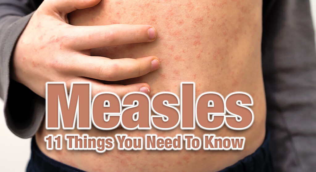 Measles is more than just a rash-- it is caused by the most contagious virus known to man. Measles causes a respiratory illness with high fevers, tiredness, painful runny nose, cough, and red eyes, followed a characteristic rash. Image for illustration purposes