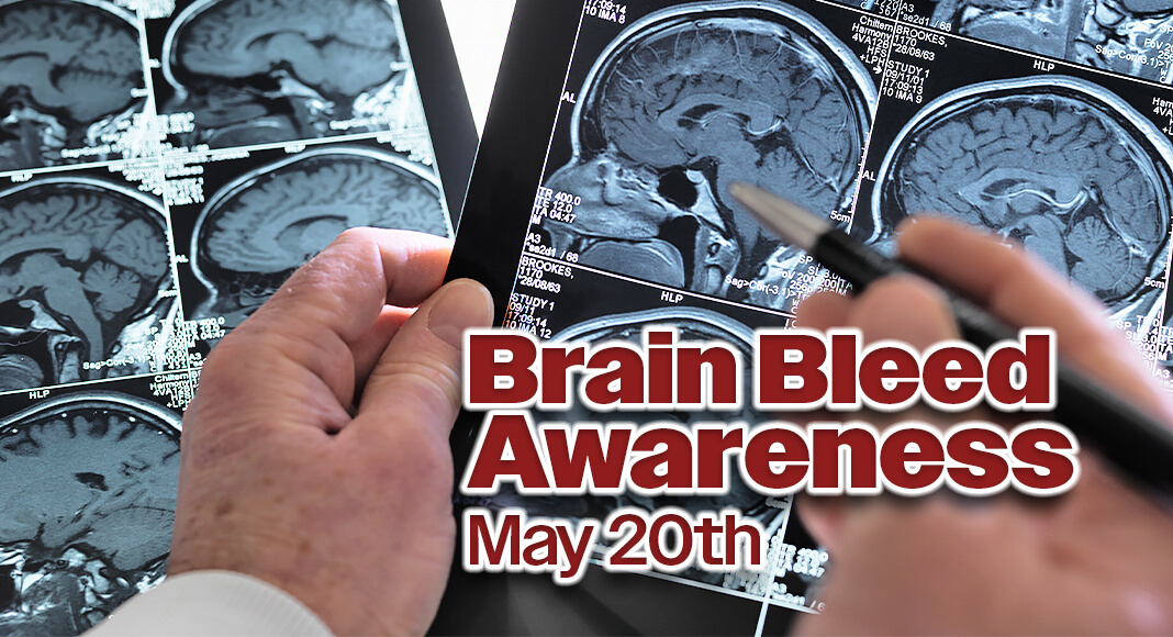 For the next installment of its monthly Let’s Talk Your Health webinar series, STHS will highlight the riskfactors, symptoms and complications associated with brain bleeds. Image for illustration purposes.