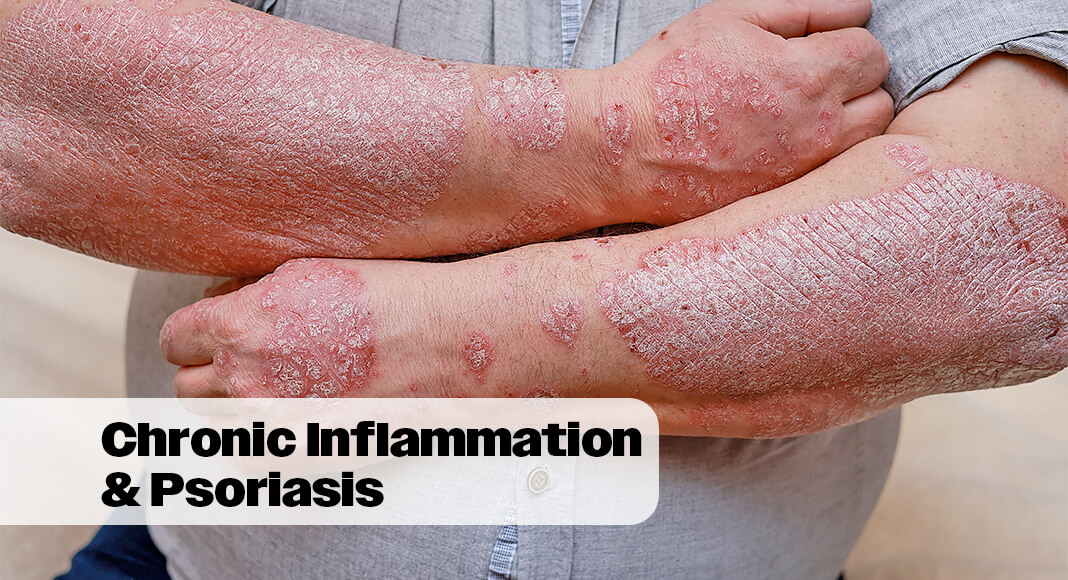 Although the exact cause of psoriasis is unknown, doctors consider it an immune-mediated inflammatory disease. This means that inflammation is at the root of this condition. Image for illustration purposes