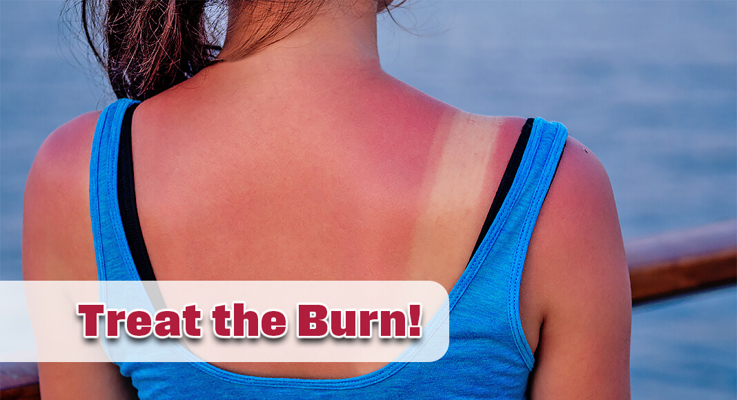 Above all, Dr. Lucas stressed that it’s best to prevent sunburn in the first place by using sunscreen. Image for illustration purposes