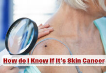 Moles, Spots, and Changes: How to Tell If Itās Skin Cancer