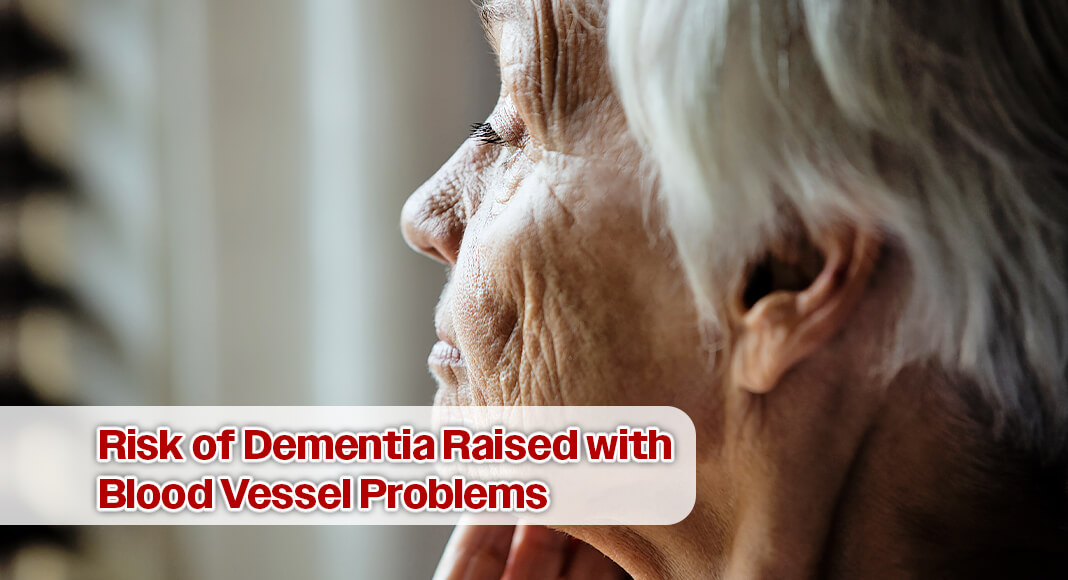 The factors that raise the risk of heart disease and stroke can also raise the risk of dementia. When blood vessels are damaged or blocked, it can deprive your brain of vital oxygen and nutrients, and that could lead to vascular dementia. Image for illustration purposes