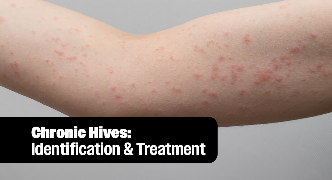 A new international study led by researchers at McMaster University has identified the most effective and safest treatments for people suffering from chronic urticaria, more commonly known as chronic hives. Image for illustration purposes