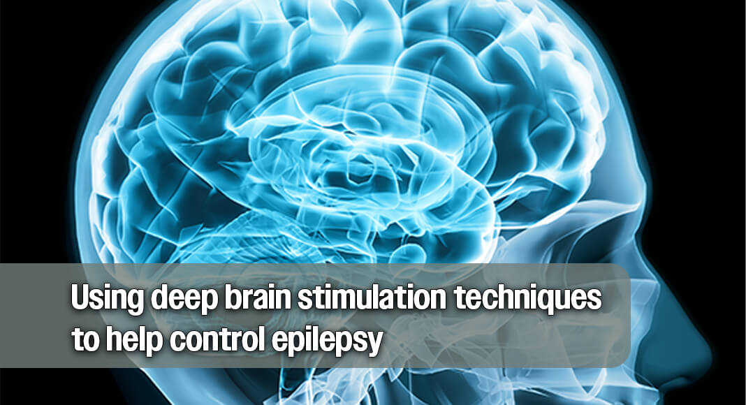 Medication has long been the cornerstone of treatment for people with epilepsy, but it doesn't stop seizures for everyone and may come with significant side effects. Image for illustration purposes