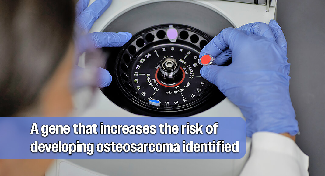 Researchers at Cleveland Clinic Children’s have helped identify a gene that increases the risk of developing osteosarcoma, which is the most common type of bone cancer in children and young adults. Image for illustration purposes