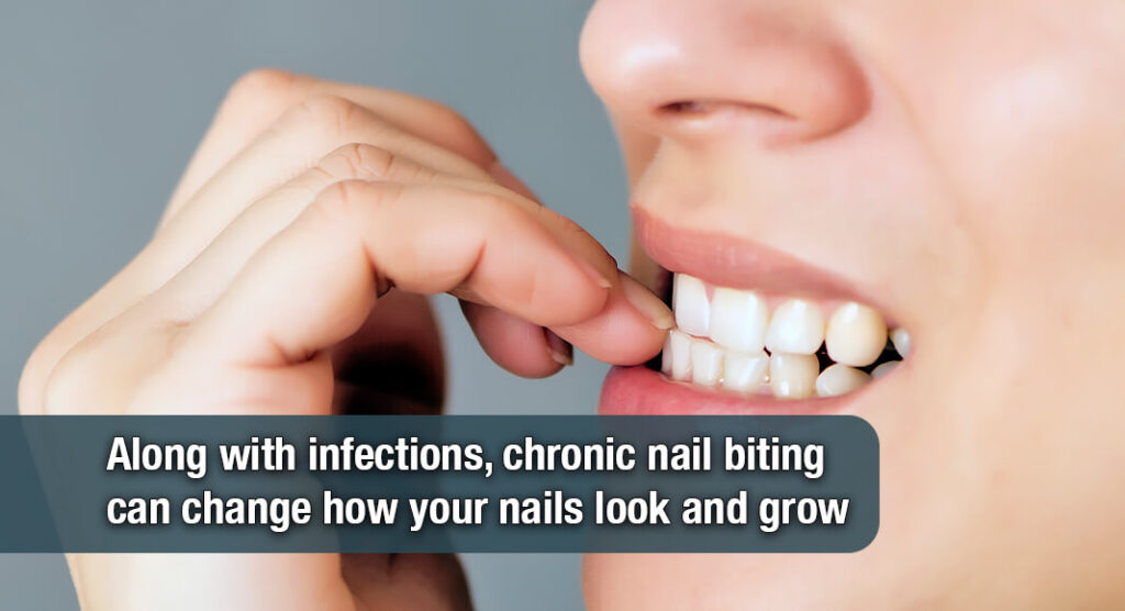 Biting Your Nails is Risky Business - Mega Doctor News