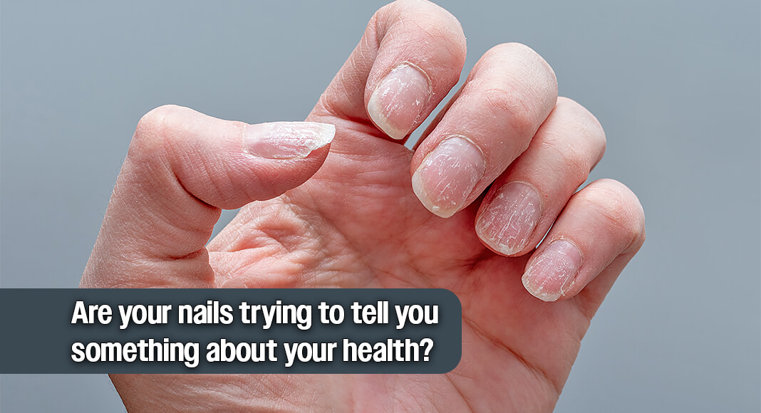“Your nails can indicate benign conditions, offer insight into your mental health and can actually be a harbinger of cancer in some cases," explained Neha Vyas, MD, a family medicine physician at Cleveland Clinic. Image for illustration purposes