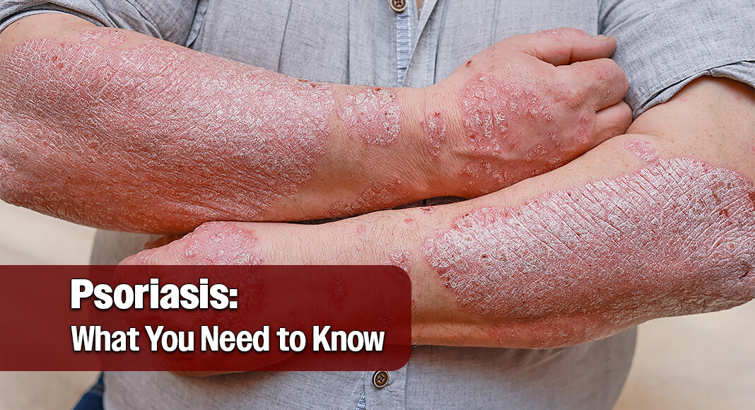 The affected areas may be pink, coral, or red, especially on light skin. On skin of color, the areas may instead be purple, violet, or gray. Image for illustration purposes