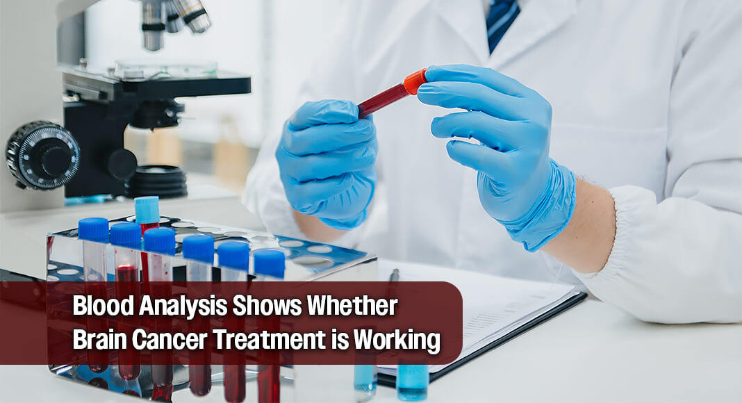 The effectiveness of chemotherapy for brain cancer, done with a technique that opens the blood-brain barrier, can be monitored by blood draw, researchers at Northwestern Medicine and the University of Michigan have shown. Image for illustration purposes