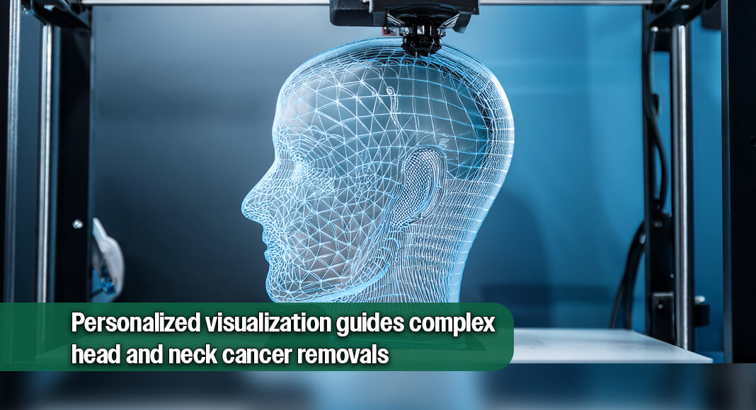 Using custom 3D-printed models to plan head and neck cancer surgeries increased precision, achieving complete tumor removal in 92% of cases with bone invasion in a recent study published by The Ohio State University Comprehensive Cancer Center – Arthur G. James Cancer Hospital and Richard J. Solove Research Institute (OSUCCC – James). Image for illustration purposes