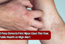 El Paso Public Health Officials Confirm First Case of Mpox in 2025