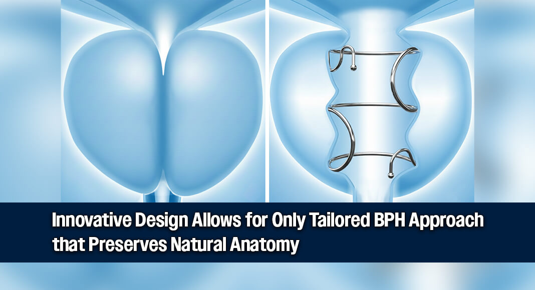 Zenflow, Inc. announced the U.S. Food and Drug Administration (FDA) approval of the Zenflow Spring® Implant and Delivery System for the treatment of symptoms associated with benign prostatic hyperplasia (BPH), also known as enlarged prostate. Image courtesy of Zenflow via Globe Newswire