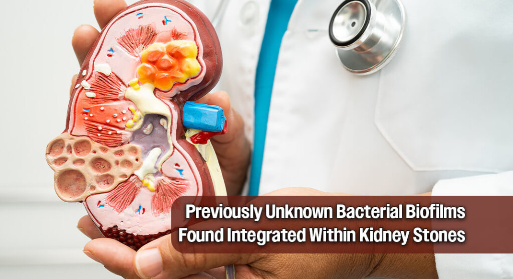 UCLA Researchers Identify Bacterial Role in Kidney Stone Formation