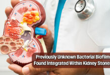 UCLA Researchers Identify Bacterial Role in Kidney Stone Formation