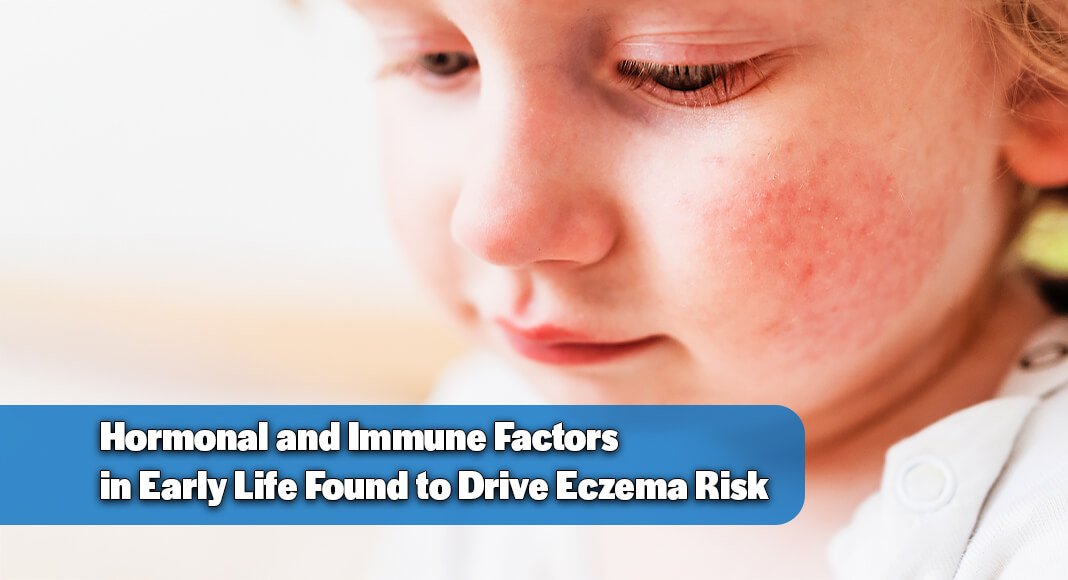 A team of researchers at the Icahn School of Medicine at Mount Sinai, Weill Cornell Medicine, and other institutions have uncovered a key biological explanation for why eczema so often starts in childhood. The study, in young mice, found that some types of immune cells in early-life skin are more reactive than those in adults, a difference that may help explain why children are more vulnerable to inflammation and allergic skin disease. Image for illustration purposes