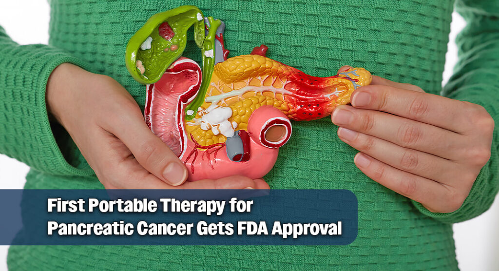 Breakthrough TTFields Technology Gets FDA Approval for Pancreatic Cancer Treatment