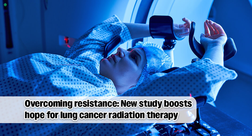 In a preclinical study published today in Cancer Research, a journal of the American Association for Cancer Research, researchers at The University of Texas MD Anderson Cancer Center identified one way lung cancer becomes resistant to radiation therapy and then developed a strategy to overcome this challenge. Image for illustration purposes