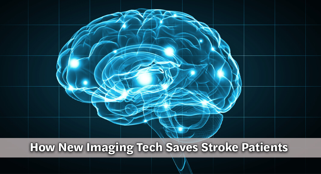 In addition to studying and implementing ways to treat patients faster, investigators have been studying how to make predicting and treating stroke more precise. Image for illustration purposes