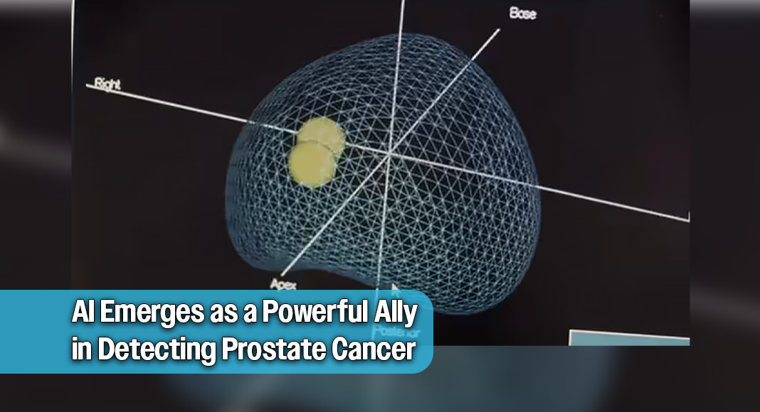 “MRI is used to help the urologists decide whether or not the patient needs a biopsy and also to decide where the sample of tissue needs to come from in order to accurately detect the cancer,” said Andrei Purysko, MD, diagnostic radiologist at Cleveland Clinic. Image courtesy of Cleveland Clinic