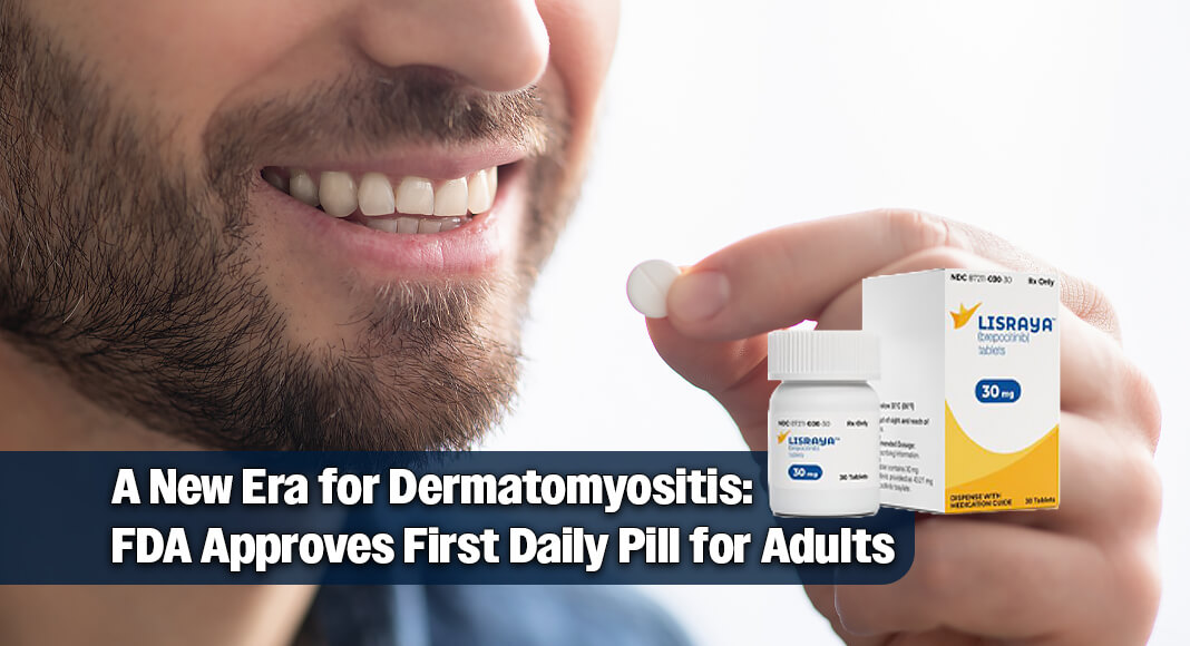 Lisraya is the first FDA-approved oral treatment option for patients with dermatomyositis, addressing the high unmet need for this rare disease. Image source: X. Bgd for illustration purposes