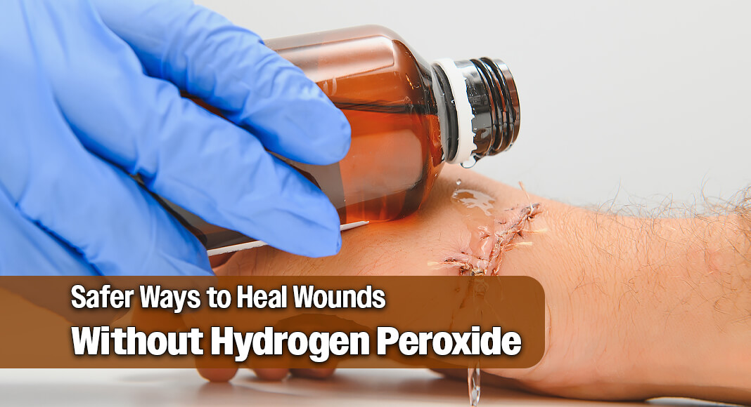 Growing up, you may have heard that you should treat open wounds with hydrogen peroxide, but that’s no longer the case. Image for illustration purposes