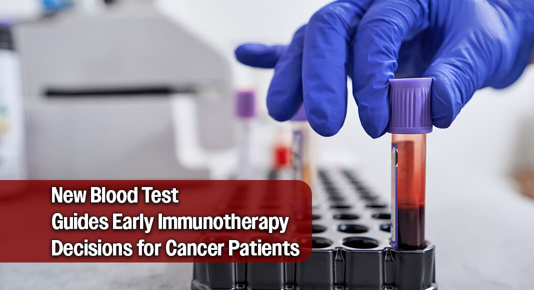 Researchers at the Johns Hopkins Kimmel Cancer Center and its Bloomberg~Kimmel Institute for Cancer Immunotherapy determined that liquid biopsy—a blood test that detects circulating tumor DNA (ctDNA)—can predict, within a few weeks, whether patients with advanced non-small cell lung cancer are benefiting from immunotherapy. Image for illustration purposes