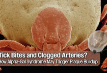 Tick Bites & Arterial Plaque: The Alpha-Gal Link